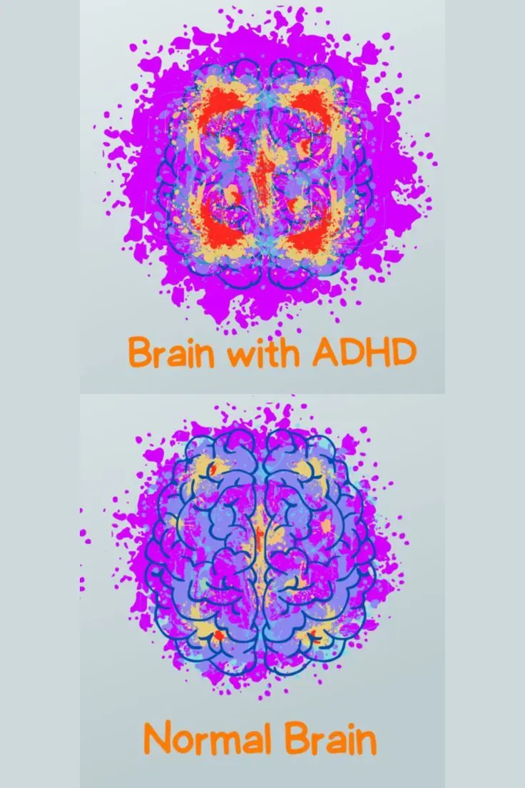 عریف اختلال ADHD و بیش‌فعالی، تفاوت آن با شیطنت و بیماری